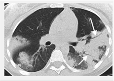 Các dấu hiệu trên hình ảnh X.Quang và CT ngực - Collins, Jannette; Stern, Eric J